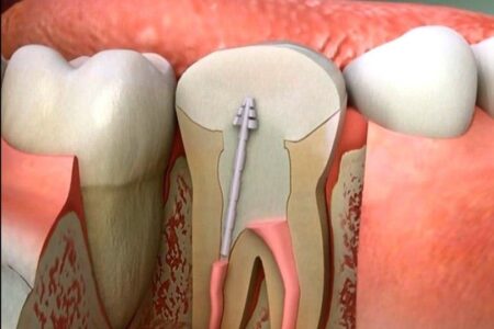 ما هي أعراض التهاب جذر السن؟